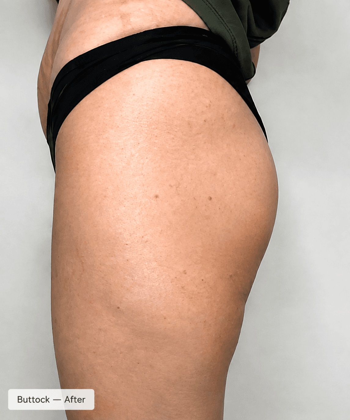 Body Volumisation — Before