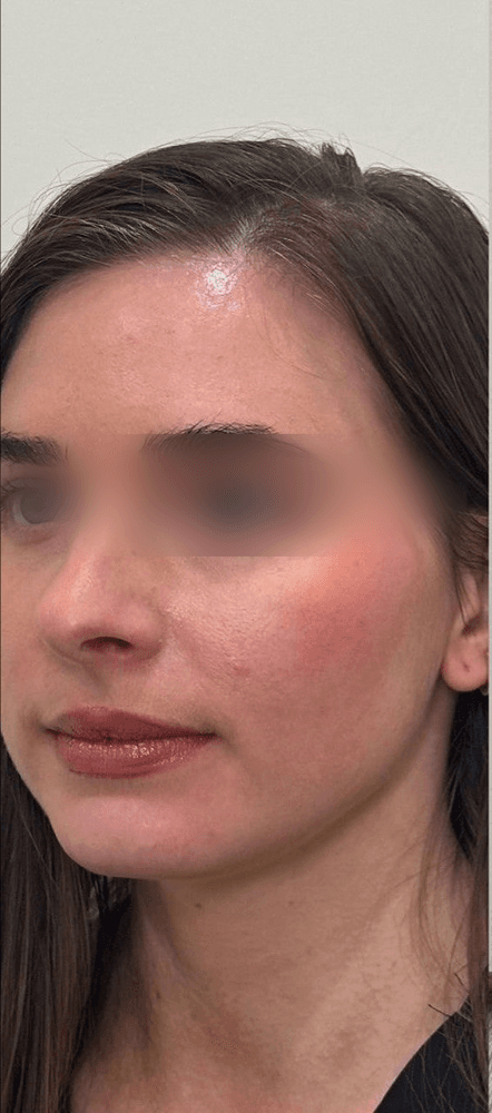 Under-Eye & Cheek Rejuvenation — Before