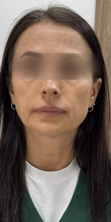 Facial Rejuvenation — Before