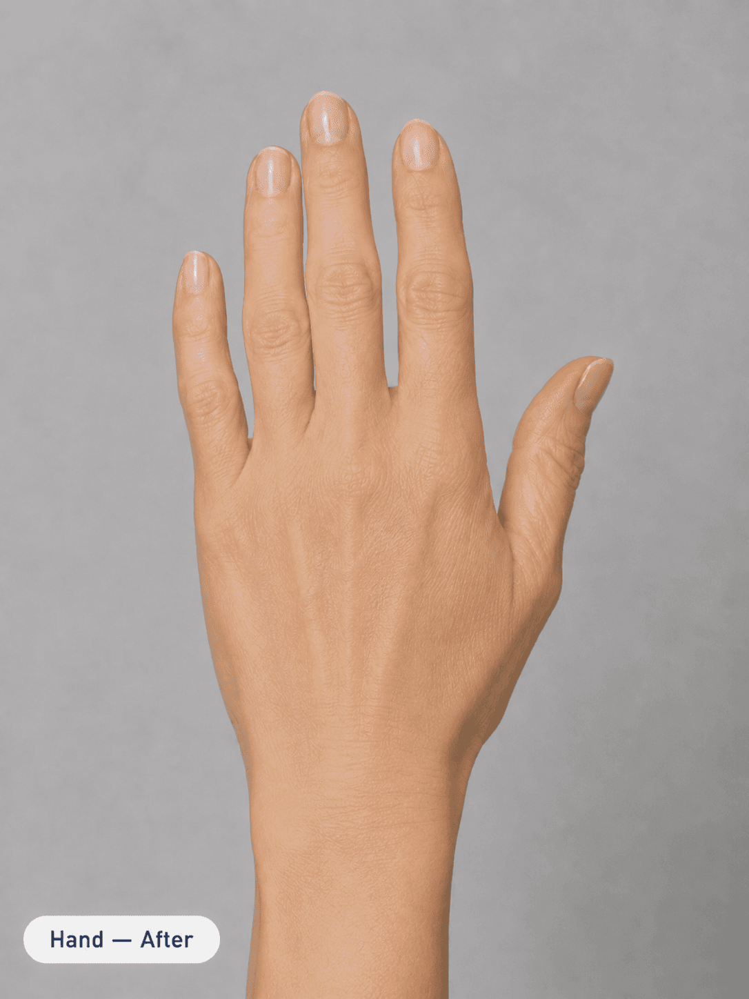 Hand rejuvenation & brightening — After