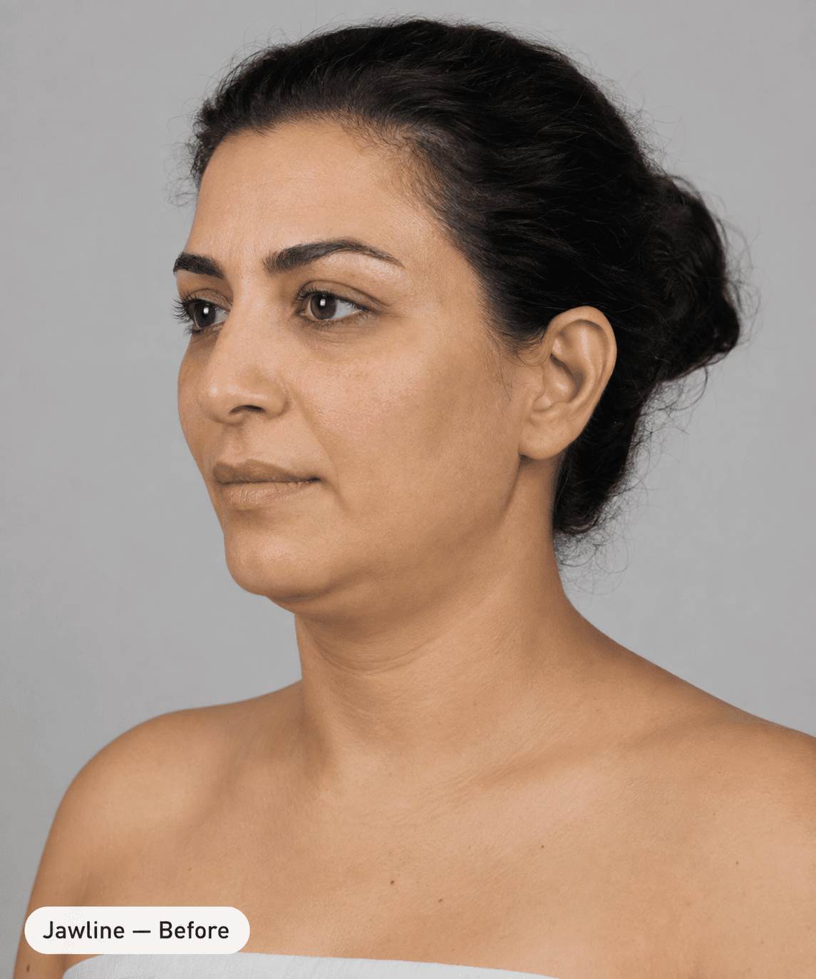 Jawline contour — Before