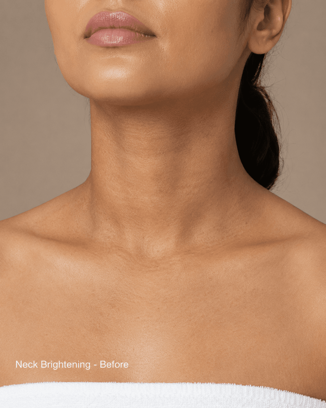 Neck & décolleté rejuvenation — Before