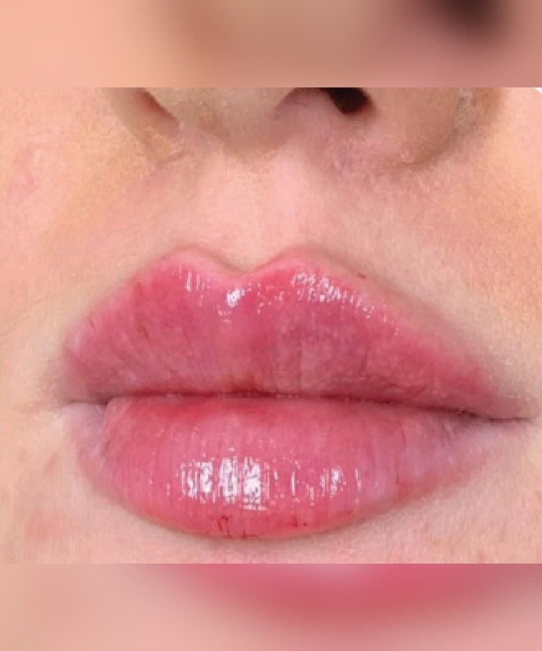 Lip volume & definition — After