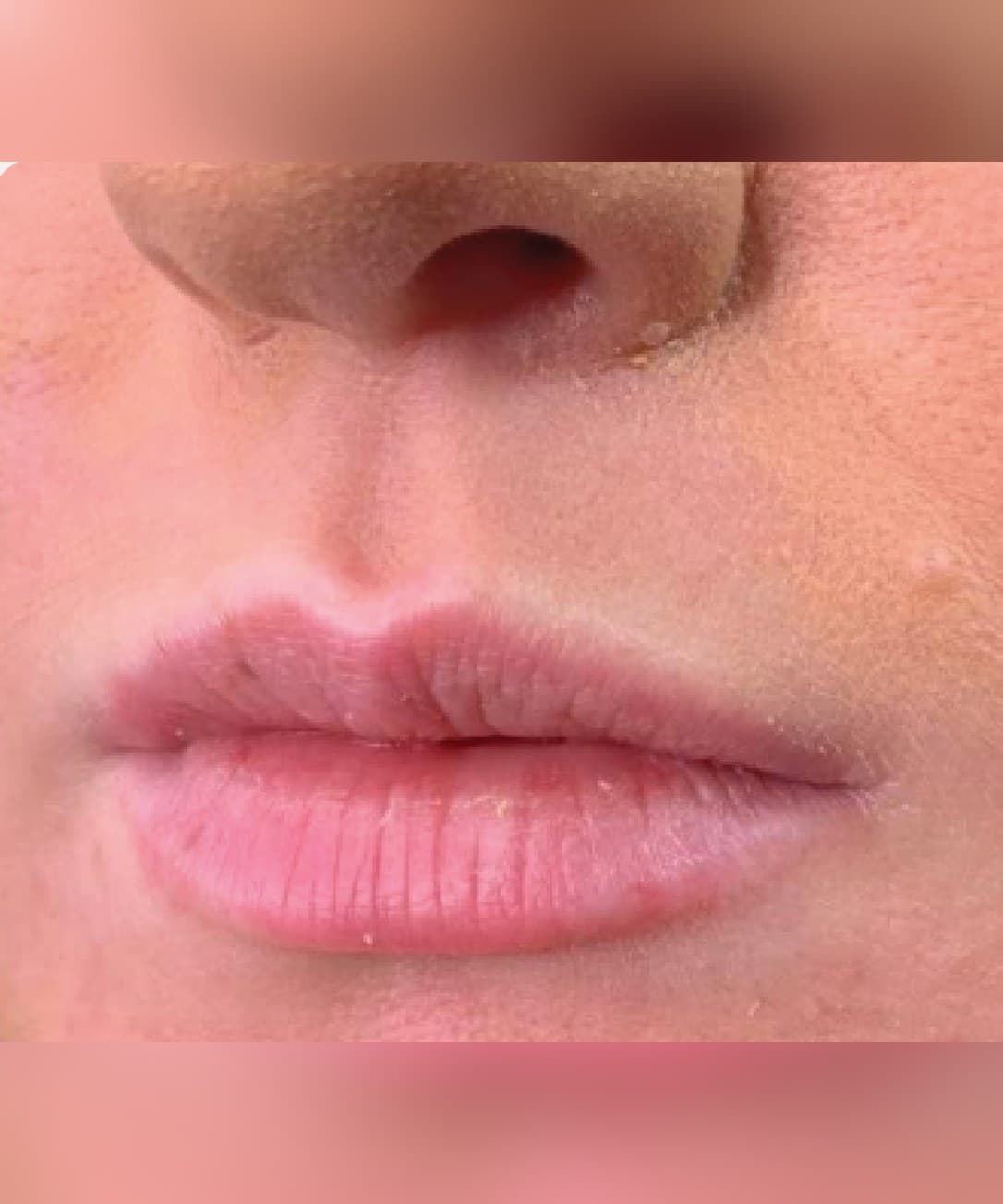 Lip volume & definition — Before