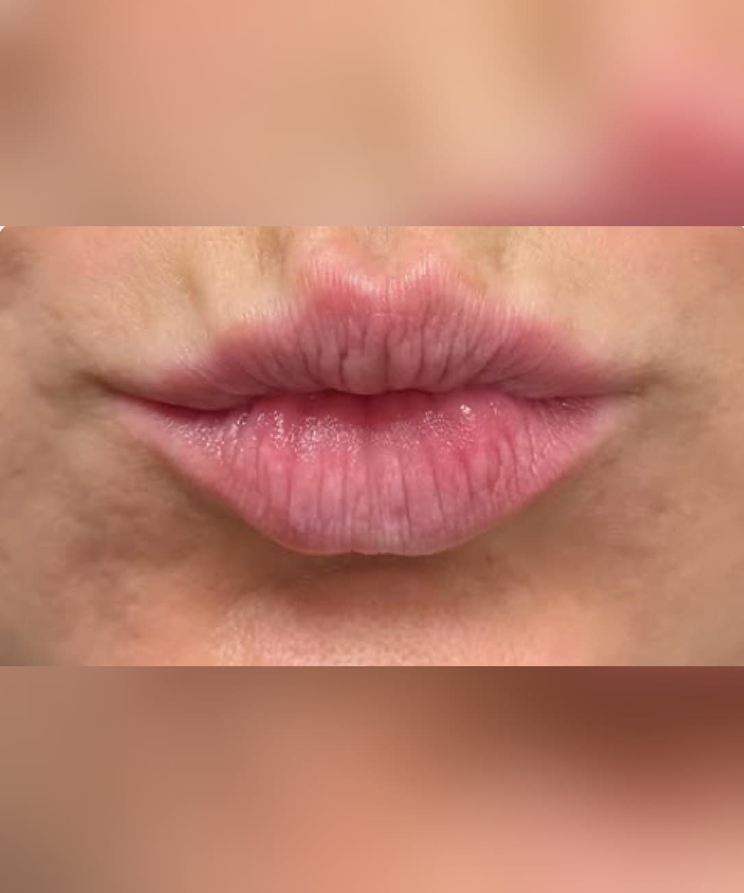 Lip plumping & hydration — Before